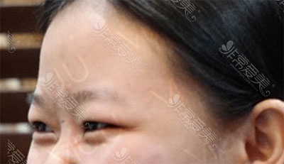 韩国VIUU崔宇景双眼皮手术案例
