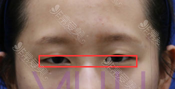 韩国VIUU双眼皮整形案例