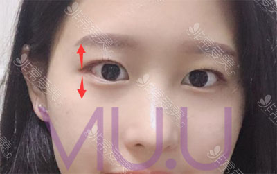 韩国崔宇景眼鼻综合手术60天前后对比日记图