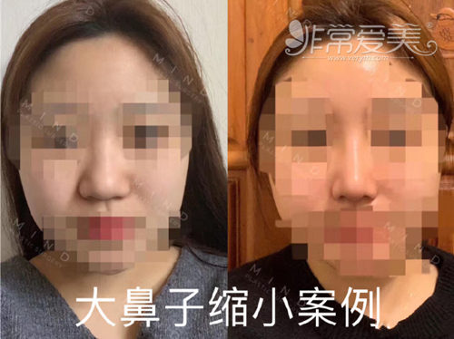 韩国MIND整形外科缩鼻翼会留疤吗？缩小鼻翼需要多少钱？