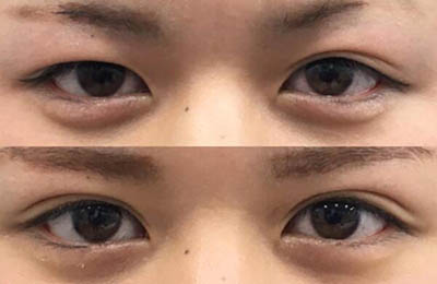 日本阪田美容整形外科眼部整形前后对比照片