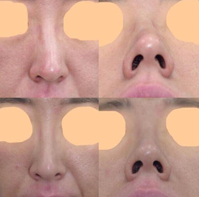 日本坂田美容整形外科歪鼻矫正前后照片