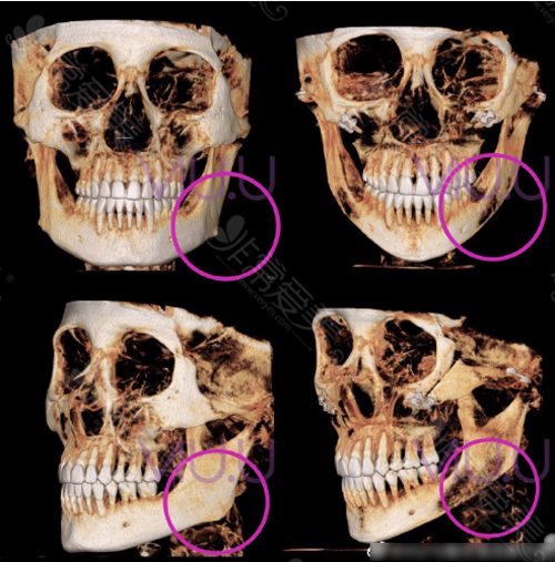 轮廓手术前后CT对比图