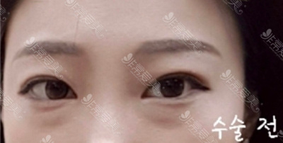 韩国眼袋案例分析，图片告诉你去眼袋手术能维持几年