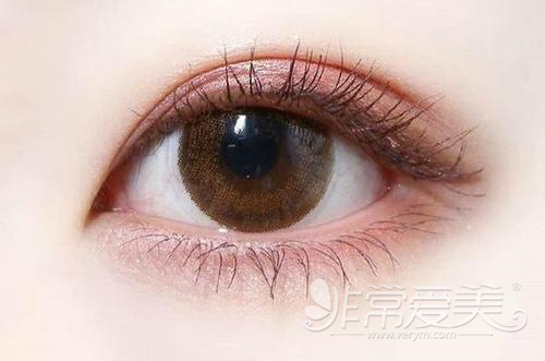 韩国眼袋日记分析，图片告诉你去眼袋手术能维持几年