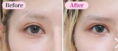 日本高须美容整形外科眼部手术前后对比照片