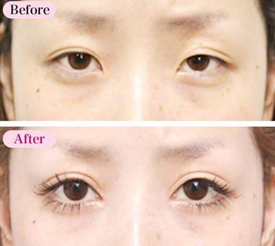 日本高须美容整形外科眼部整形前后对比照