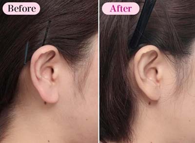 日本高须美容整形外科耳朵矫正前后对比照