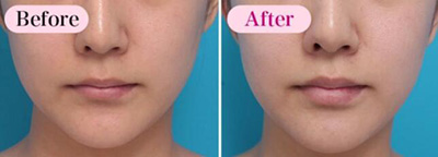 日本高须美容整形外科唇部玻尿酸注射前后对比照