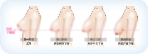 韩国整形医院有哪些方法可以处理胸部下垂，效果怎么样？