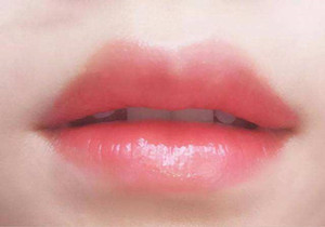 唇部厚的人可以通过唇部缩小手术获得迷人唇形