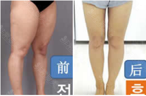 韩国365MC医院腿部吸脂