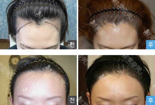 韩国毛发移植医院哪家好移植发际线的原理是什么