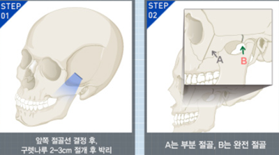 韩国丽温医院颧骨手术从发际线切口