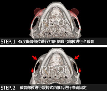 韩国丽温医院颧骨手术无钛钉固定CT图