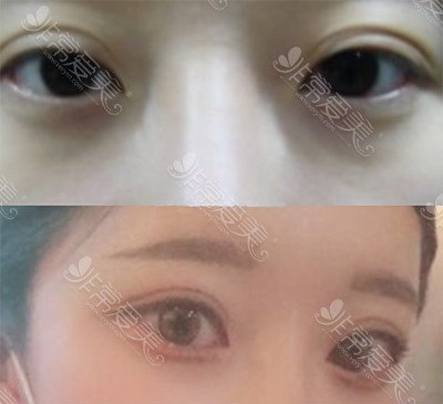 韩国纯真医院双眼皮手术对比图