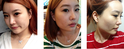 我在韩国topclass做轮廓+双眼皮的真实经历分享！