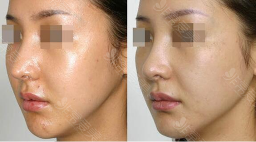 隆鼻皮肤越来越薄如何修复？韩国这几家医院技术值得看！