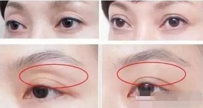 韩国ace医院眼窝填充手术真人图