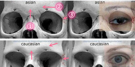 东西方人眉骨部分CT展示图