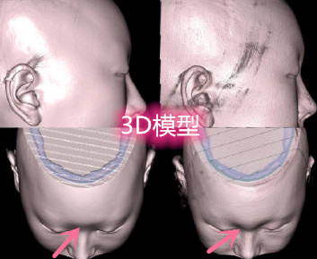 韩国H白汀桓医院会通过3D进行模拟丰眉弓