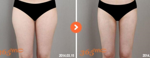 韩国365mc医院腿部吸脂