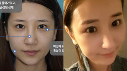 韩国碧夏整形医院隆鼻案例前后对比图