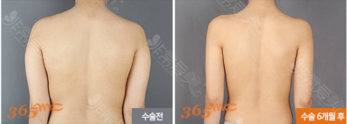 韩国365mc医院背部吸脂手术