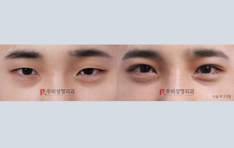 韩国如妃整形外科双眼皮整形案例