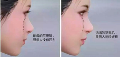 为什么说有苹果肌的女人是富贵相,如果苹果肌下垂该怎么办