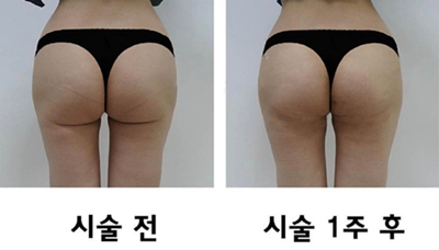 韩国HARU医院臀部提升效果图