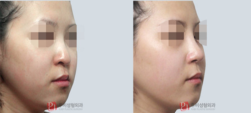 韩国ruby整形外科隆鼻手术对比案例 
