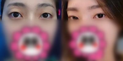 韩国纯真医院双眼皮手术图