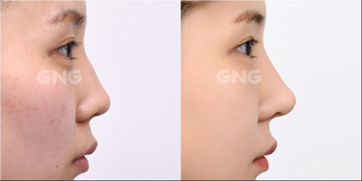 韩国GNG医院隆鼻前后对比图