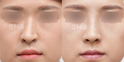 韩国GNG医院无假体隆鼻可以降低隆鼻副作用