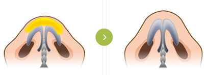 球形鼻尖的蒜头鼻手术方法示意图