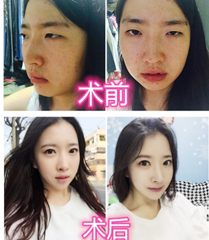 韩国灰姑娘整形外科眼综合手术对比图