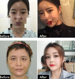 韩国绮林整形外科眼综合前后对比图
