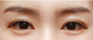 韩国绮林整形外科眼睑下垂技术好