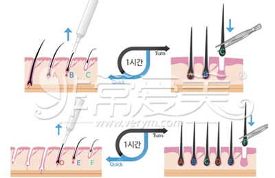 韩国毛囊移植手术方法图