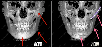 韩国TS医院轮廓手术前后CT对比