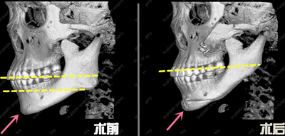 韩国TS整形外科下颌骨手术CT照片