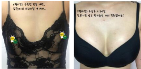 韩国PJS朴真奭医院隆胸前后对比图