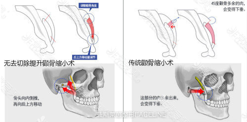 韩国颧骨整形方法图