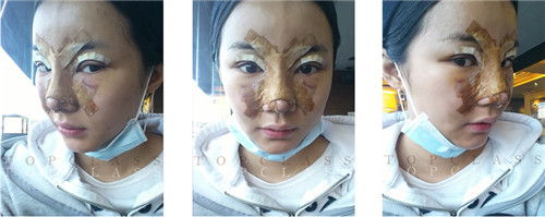 韩国topclass眼型矫正术后恢复第五天
