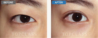 韩国topclass整形双眼皮手术前后后对比图