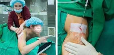 韩国365MC医院l兰斯吸脂手术实拍