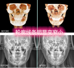 韩国菲斯莱茵faceline医院轮廓手术前后对比图