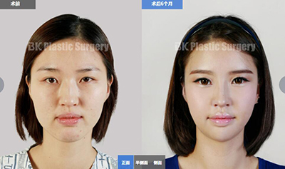韩国BK自体脂肪移植前后对比照片