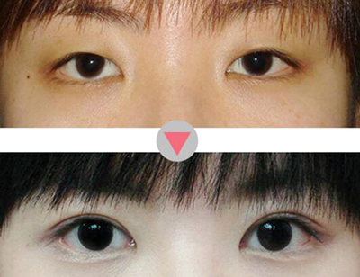 韩国BK眼部整形前后对比照片